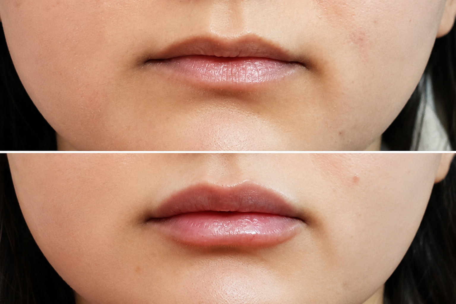 Lip Fillers